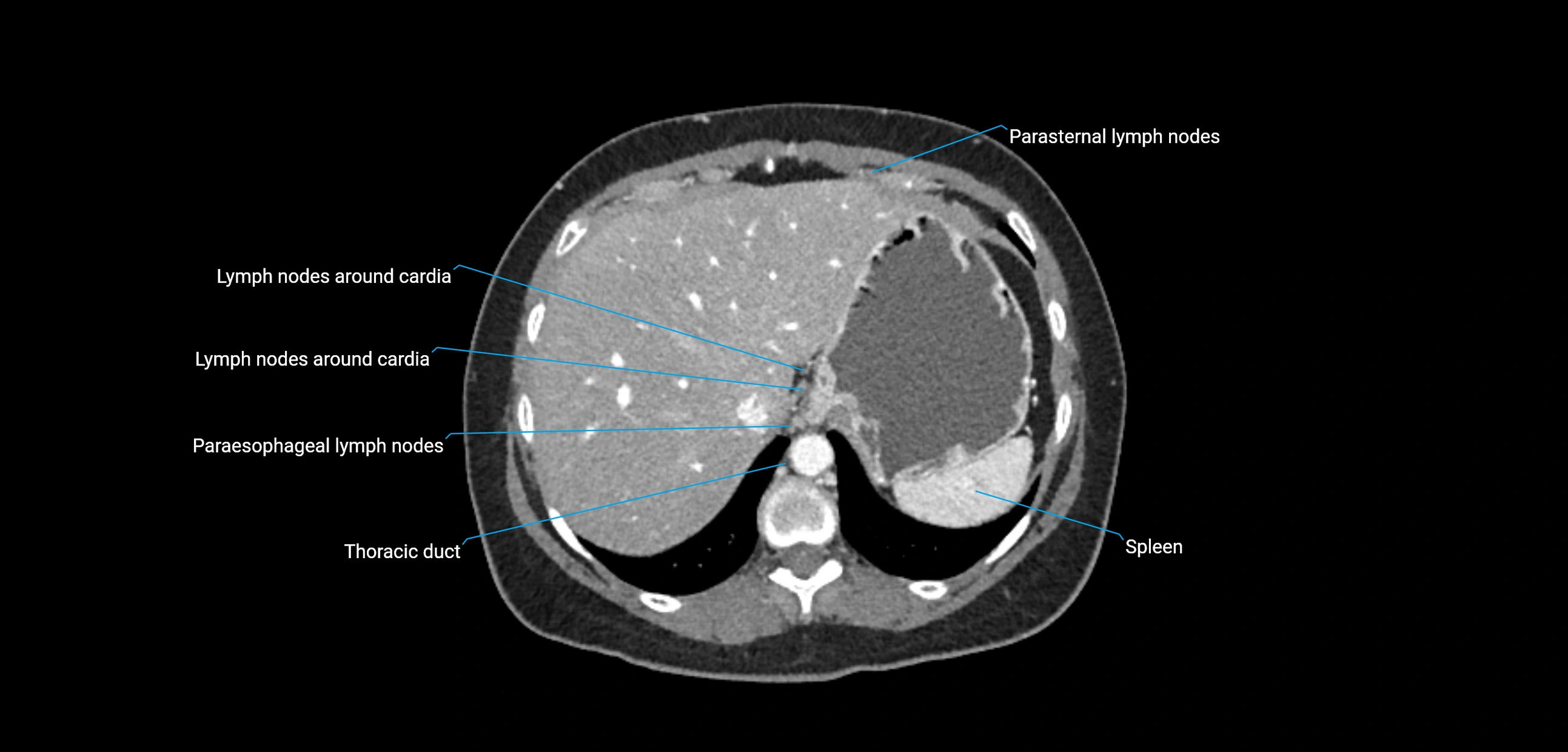 CT ct abdominal lymph nodes  axial cross sectional anatomy  enchanced radiology image -img-00002-00096.webp